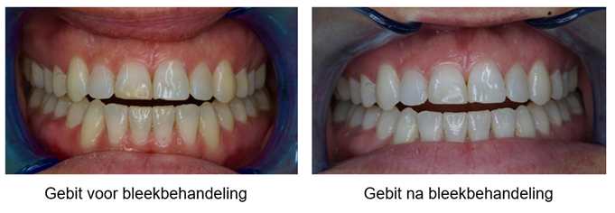 foto's van een gebit vóór een bleekbehandeling en hetzelfde, wittere gebit na een bleekbehandeling