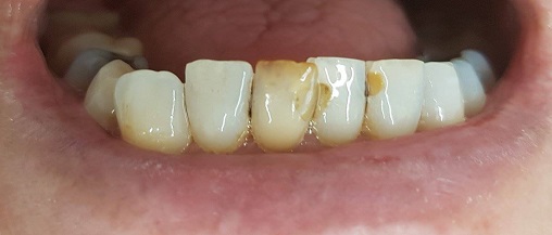 gebit na 1 week intern tanden bleken