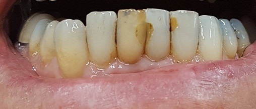 gebit na 2 weken intern bleken